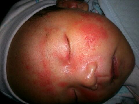 治疗湿疹要不要用激素药,湿疹不含激素药膏