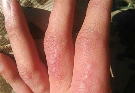 手起透明的小水泡怎么回事汗疱疹,手上起小水泡汗疱疹是真菌感染吗