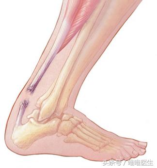 患者答疑—韧带损伤的治疗及注意事项，过早过晚都不好！