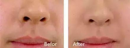 不要轻易的尝试脱毛,脱毛时大家都在做什么