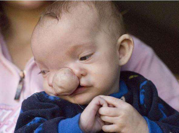 一个小孩一出生就长着猪鼻子,刚出生的婴儿猪鼻子