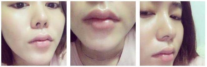 玻尿酸丰唇即刻效果,玻尿酸丰唇有几种唇型