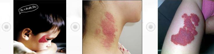 鲜红斑痣专家,鲜红斑痣一定要治疗吗