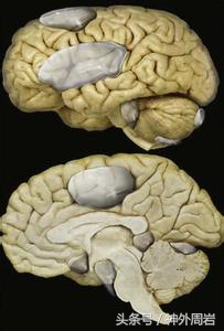颅内蛛网膜囊肿有症状不及时治疗,颅内多发蛛网膜囊肿怎么治