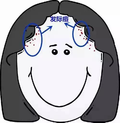 痘痘里挤出来的白色的痘痘怎么办,手臂上有很多痘痘挤出来是白色的