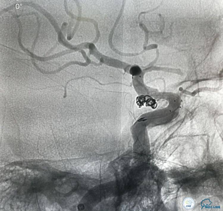 支架辅助弹簧圈栓塞治疗狭窄伴复杂动脉瘤