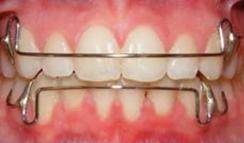 矫正的牙齿又反弹了怎么补救,矫正过的牙齿又反弹了怎么办