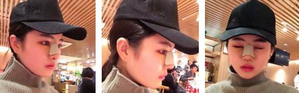 鼻综合7天山根很肿,做完膨体鼻综合修复脸特别肿