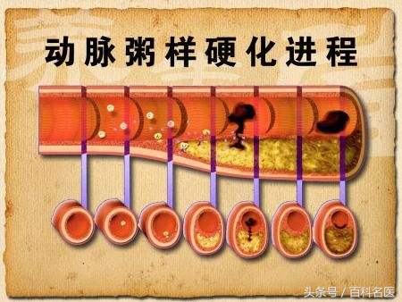 哪些人是动脉粥样硬化的高危人群,动脉粥样硬化该怎样预防和治疗