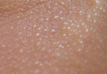 眼睛周围长满脂肪粒是怎么回事,眼睛周围长满了脂肪粒是怎么回事