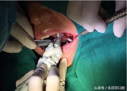 种植牙到底有多痛苦,种植牙真实经历详细全部过程