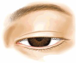 双眼皮有肉条怎么消肿最快,双眼皮术后疤痕怎么能彻底消除