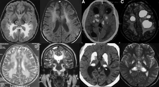 中枢神经脱髓鞘病是重大疾病吗,中枢神经系统脱髓鞘和多发性硬化