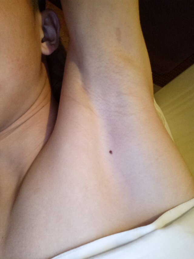 嘴角右边有痣代表什么含义女人,手指各个地方长痣的不同含义