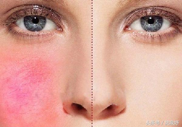 毛孔粗大不要怕一招帮你解决,毛孔粗大不用怕简单几招就解决
