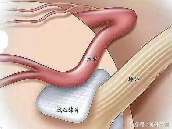 眼睑痉挛能打肉毒素治疗吗,怎么才可以治疗眼睑痉挛