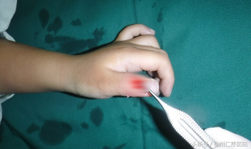 萌宠?杀器?3天内徐州仁慈医院连接2例被宠物咬伤幼童