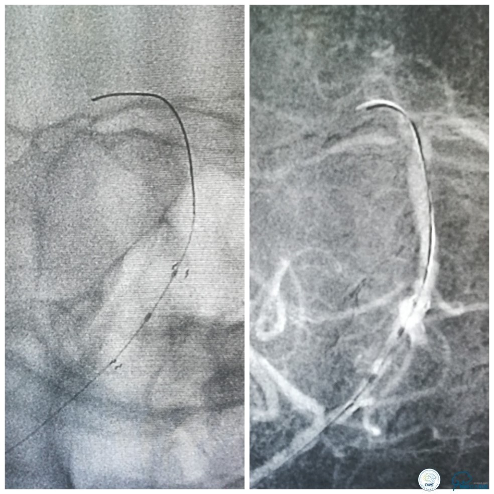 天坛周记|右椎动脉V1段及V4-基底动脉串联病变支架治疗一例