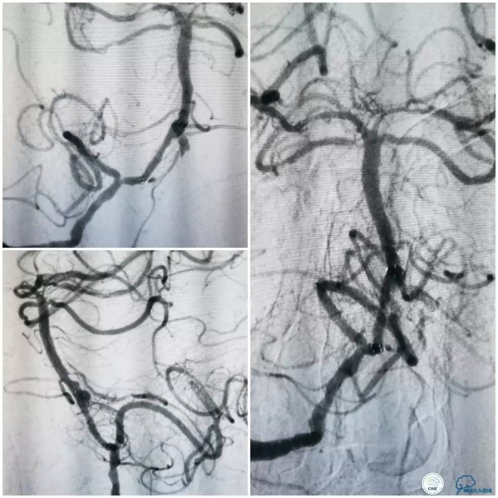 天坛周记|右椎动脉V1段及V4-基底动脉串联病变支架治疗一例