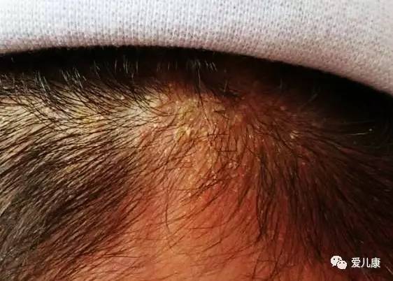 宝宝头皮脂溢性皮炎头屑图,宝宝脂溢性皮炎头皮症状图片展示