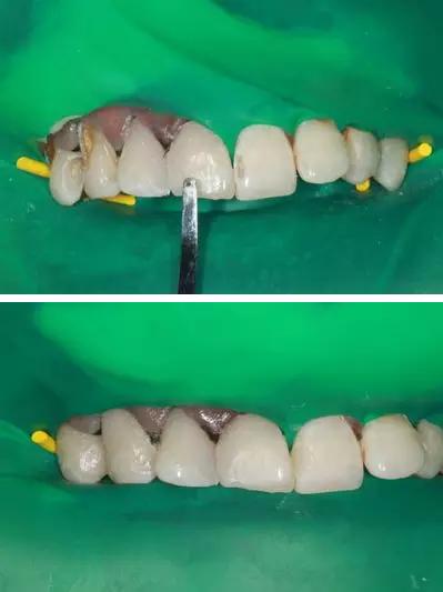 可乐牙治疗实拍,可乐牙治疗好前后图片