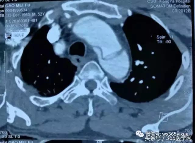 胸主动脉瘤保守治疗的方法,江西省胸科医院黄建华