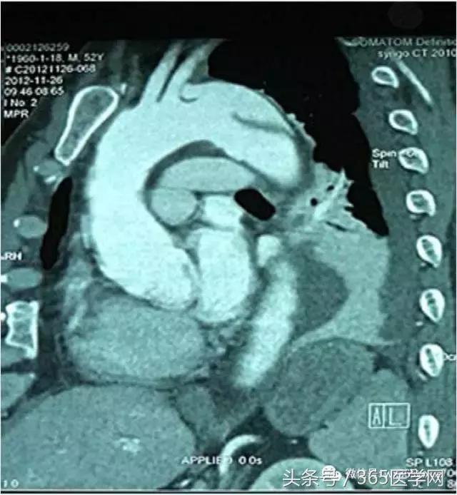 胸主动脉瘤保守治疗的方法,江西省胸科医院黄建华