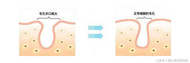 烫伤后毛孔变大会恢复正常吗,清洁毛孔后不收缩毛孔会变大吗