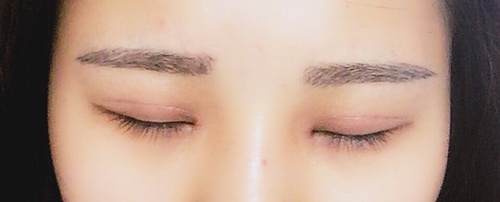 内双可以做埋线双眼皮整个过程,内双做埋线双眼皮会变成三眼皮吗