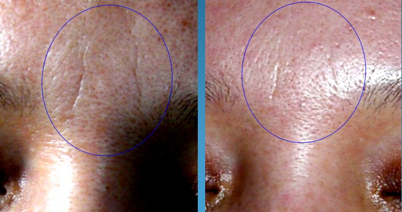 初春皮肤问题多，光子嫩肤一招制胜！