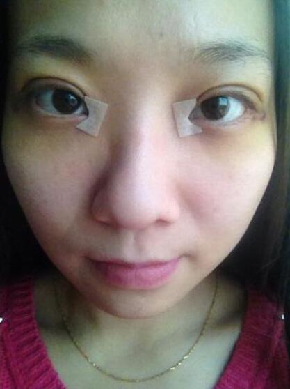 完美的埋线双眼皮,完美双眼皮