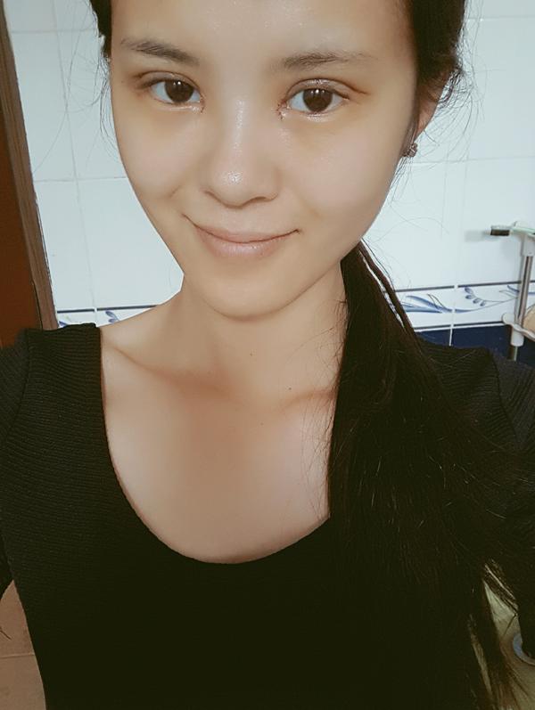 全切双眼皮15天,恢复的差不多了