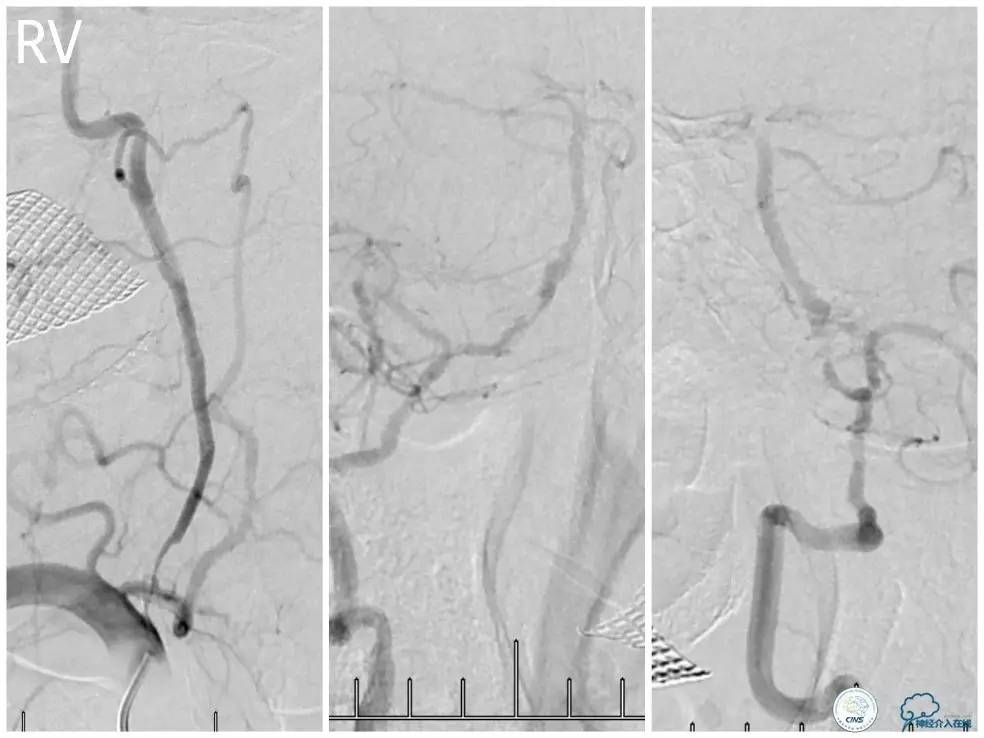 天坛周记|右椎动脉V1段及V4-基底动脉串联病变支架治疗一例