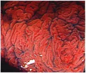 普通内镜与Pitpattern分型（多图详解）