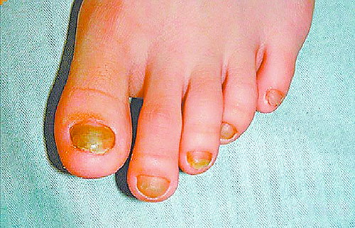 儿童吃指甲的后果,儿童刷牙吞食牙膏怎么办