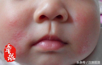 婴儿湿疹与过敏,奶粉过敏长湿疹