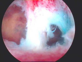 人流术后月经量明显减少或者迟迟不来，警惕是否发生了宫腔粘连？