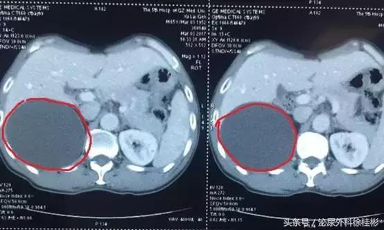 囊肿体质可以补钙吗,腰酸背痛需要补钙吗