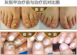 宝宝会得灰指甲什么样子,宝宝指甲像灰指甲怎么办