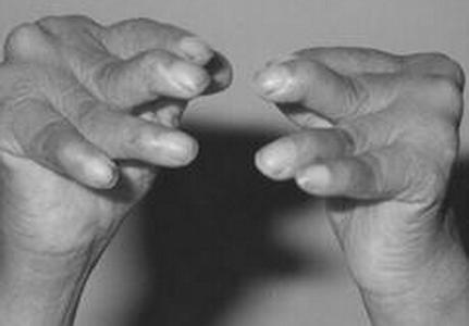 一味药威灵仙打通全身经络,一味威灵仙11种病症皆可治