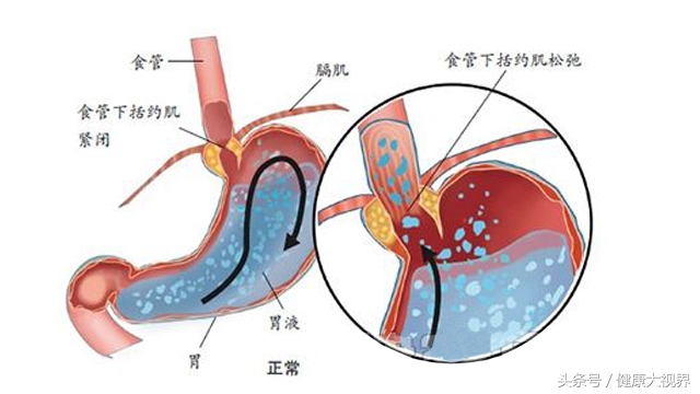 反流性食管炎胃炎中药有哪些,反流性食管炎反酸中药