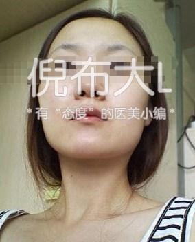 下颌角削多了变成马脸怎么修复,下颌角削骨有哪几种切法