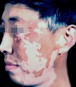 308和uvb哪个治疗白癜风好,uvb治疗白癜风