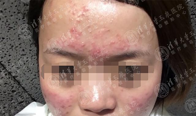 最近脸上疯狂长痘是因为换季吗,一换季脸就起痘