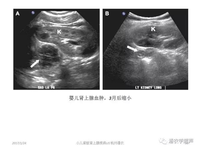 小儿肾上腺囊性占位超声表现,肾上腺疾病的影像学诊断