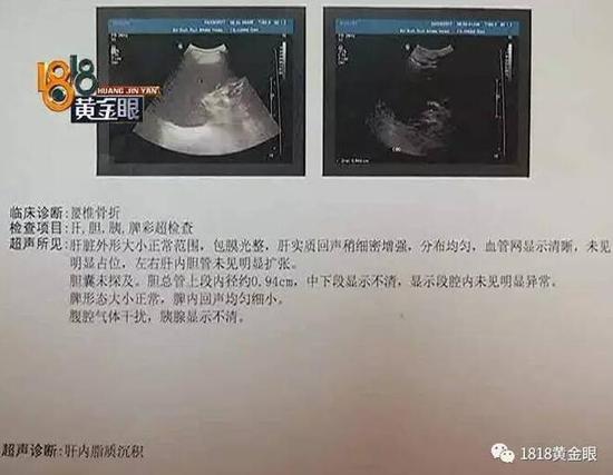 杭州老人在洗浴中心摔倒腰椎骨折后续赔偿一波三折