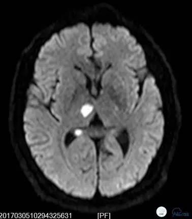 椎动脉狭窄支架植入术需要多少钱,颅内动脉狭窄支架手术后哪些症状