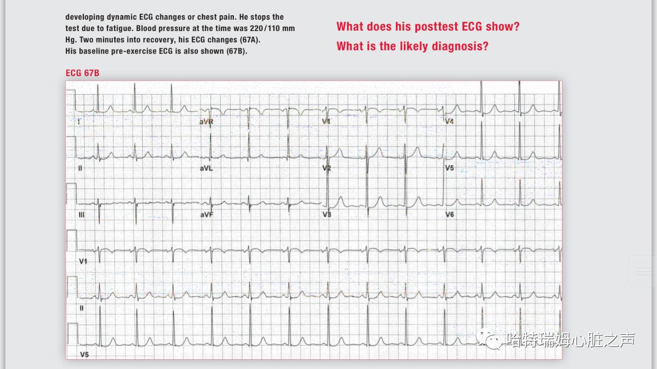 读心有术视频讲解,长期心电图提示下壁st段轻度压低