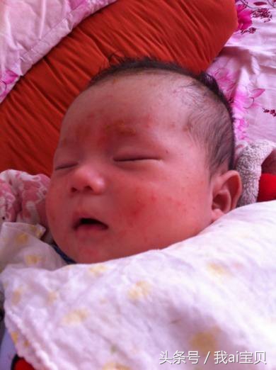 婴儿慢性湿疹怎么样好得快,婴儿湿疹久治不愈怎么办