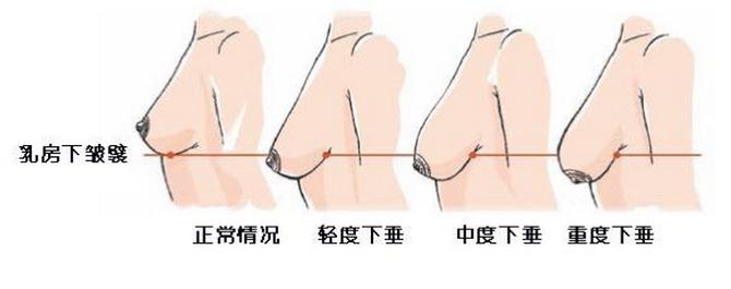 哺乳后乳房下垂怎么锻炼,哺乳后乳房干瘪萎缩下垂怎么办